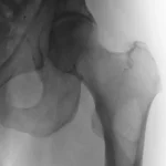 Vascular Intervention